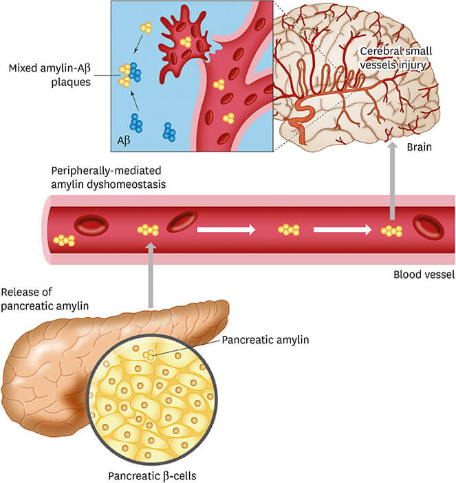 Diabetes-related amylin dyshomeostasis leads to the pancreatic amyloid formation.